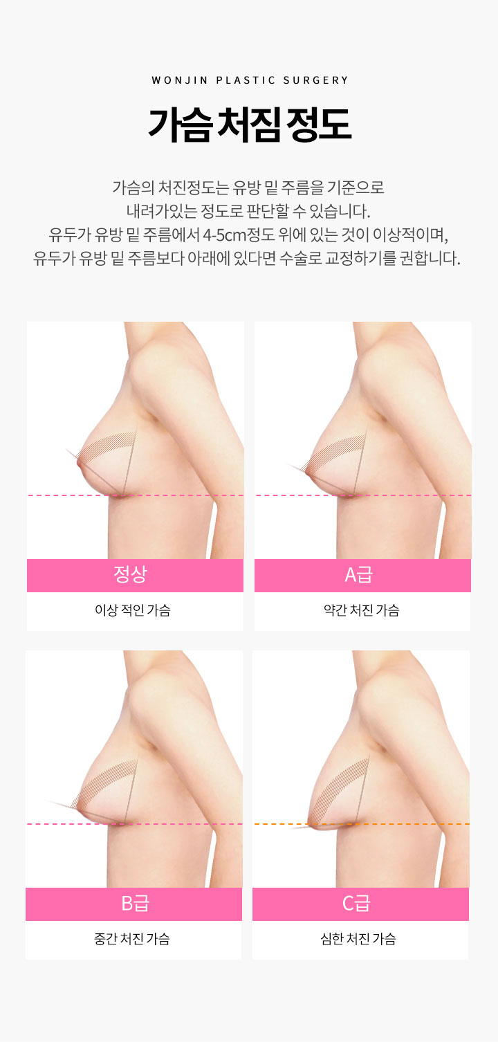 가슴 처짐 정도
		가슴의 처진 정도는 유방 밑 주름을 기준으로 내려가있는 정도로 판단할 수 있습니다.
		유두가 유방 밑 주름에서 4-5cm정도 위에 있는 것이 이상적이며, 유두가 유방 밑 주름보다 
		아래에 있다면 수술로 교정하기를 권합니다. 
		정상 -  이상 적인 가슴
		A급 - 약간 처진 가슴
		B급 - 중간 처진 가슴
		C급 - 심한 처진 가슴