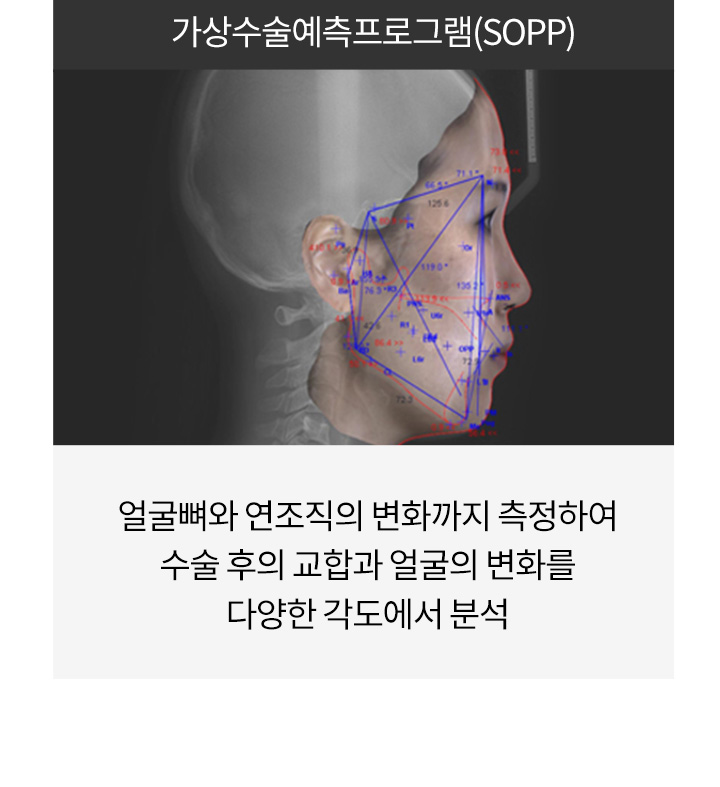 가상수술예측프로그램(SOPP)
		얼굴뼈와 연조직의 변화까지 측정하여
		수술 후의 교합과 얼굴의 변화를
		다양한 각도에서 분석