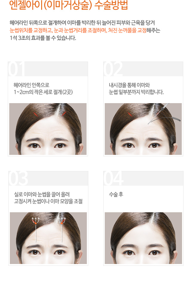 엔젤아이(이마거상술) 수술방법
헤어라인 뒤쪽으로 절개하여 이마를 박리한 뒤 늘어진 피부와 근육을 당겨
눈썹위치를 교정하고, 눈과 눈썹거리를 조절하며, 처진 눈꺼풀을 교정해주는
1석 3조의 효과를 볼 수 있습니다.