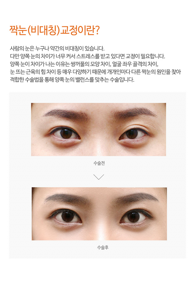 짝눈(비대칭)교정이란?
사람의 눈은 누구나 약간의 비대칭이 있습니다.
다만 양쪽 눈의 차이가 너무 커서 스트레스를 받고 있다면 교정이 필요합니다.
양쪽 눈이 차이가 나는 이유는 쌍꺼풀의 모양 차이, 얼굴 좌우 골격의 차이,
눈 뜨는 근육의 힘 차이 등 매우 다양하기 때문에 개개인마다 다른 짝눈의 원인을 찾아
적합한 수술법을 통해 양쪽 눈의 밸런스를 맞추는 수술입니다.