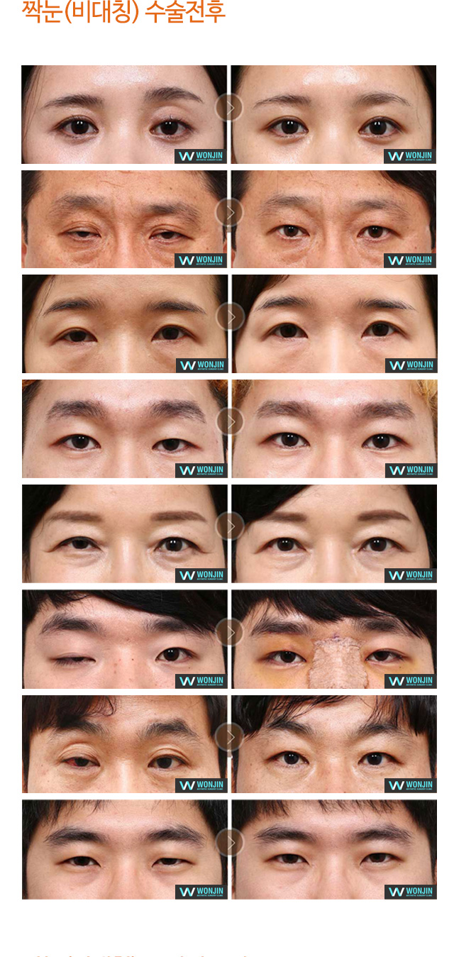 짝눈(비대칭) 수술전후