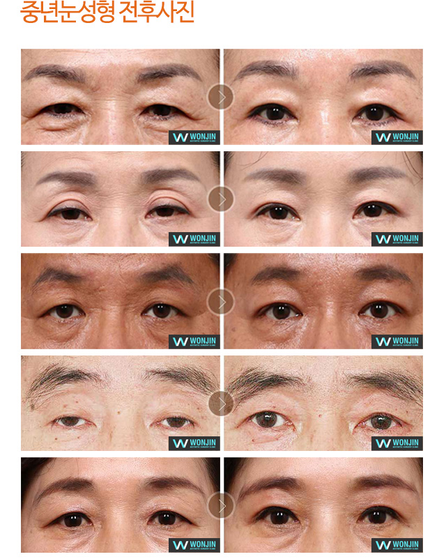 중년눈성형 전후사진