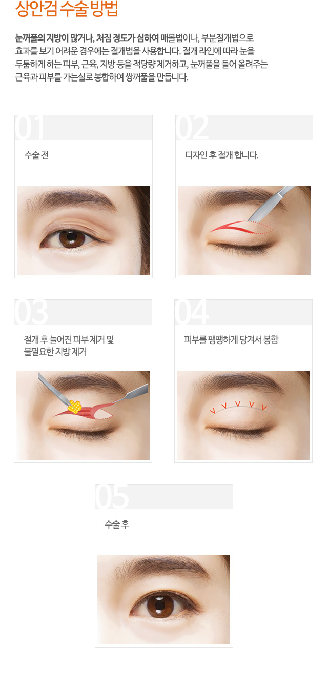 상안검 수술 방법
눈꺼풀의 지방이 많거나, 처짐 정도가 심하여 매몰법이나, 부분절개법으로
효과를 보기 어려운 경우에는 절개법을 사용합니다. 절개 라인에 따라 눈을
두툼하게 하는 피부, 근육, 지방 등을 적당량 제거하고, 눈꺼풀을 들어 올려주는
근육과 피부를 가는실로 봉합하여 쌍꺼풀을 만듭니다.