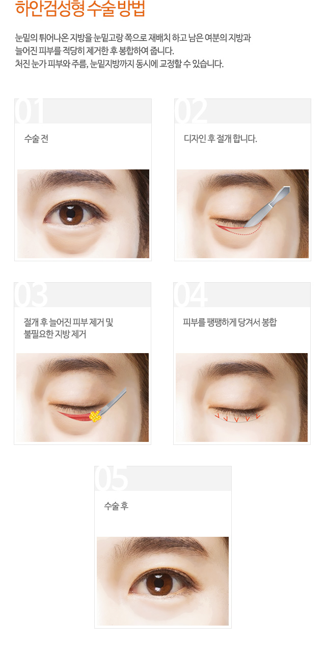 하안검성형 수술 방법
눈밑의 튀어나온 지방을 눈밑고랑 쪽으로 재배치 하고 남은 여분의 지방과
늘어진 피부를 적당히 제거한 후 봉합하여 줍니다.
처진 눈가 피부와 주름, 눈밑지방까지 동시에 교정할 수 있습니다.