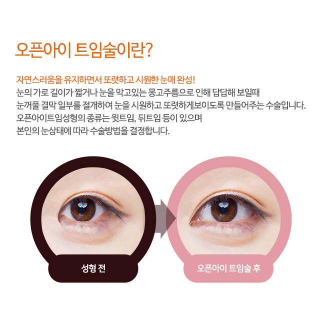 오픈아이 트임술이란?
자연스러움을 유지하면서 또렷하고 시원한 눈매 완성!
눈의 가로 길이가 짧거나 눈을 막고있는 몽고주름으로 인해 답답해 보일때
눈꺼풀 결막 일부를 절개하여 눈을 시원하고 또렷하게보이도록 만들어주는 수술입니다.
오픈아이트임성형의 종류는 윗트임, 뒤트임 등이 있으며
본인의 눈상태에 따라 수술방법을 결정합니다.