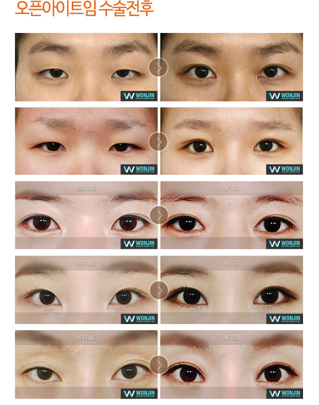 오픈아이트임 수술전후