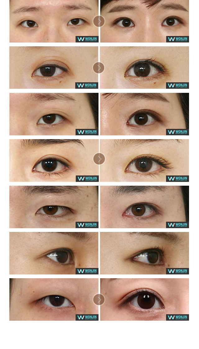 오픈아이트임 수술전후