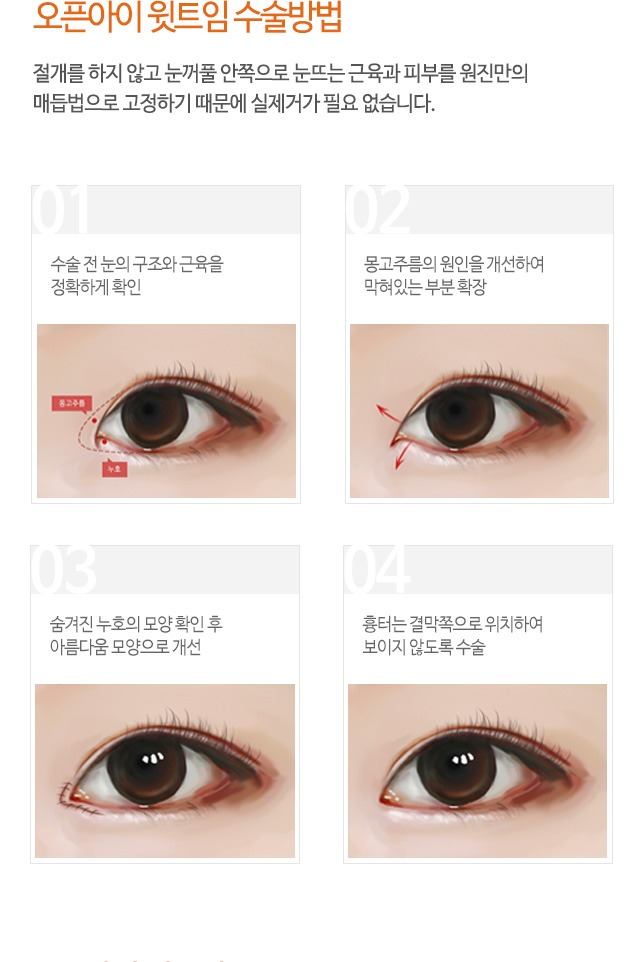 오픈아이 윗트임 수술방법
절개를 하지 않고 눈꺼풀 안쪽으로 눈뜨는 근육과 피부를 원진만의
매듭법으로 고정하기 때문에 실제거가 필요 없습니다.