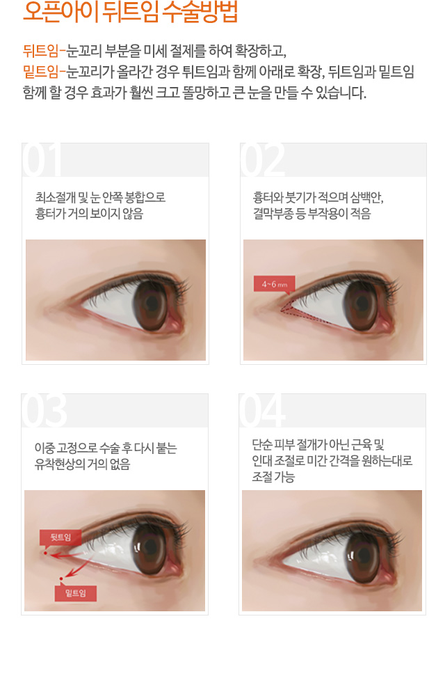 오픈아이 뒤트임 수술방법
뒤트임-눈꼬리 부분을 미세 절제를 하여 확장하고,
밑트임-눈꼬리가 올라간 경우 튀트임과 함께 아래로 확장, 뒤트임과 밑트임
함께 할 경우 효과가 훨씬 크고 똘망하고 큰 눈을 만들 수 있습니다.
