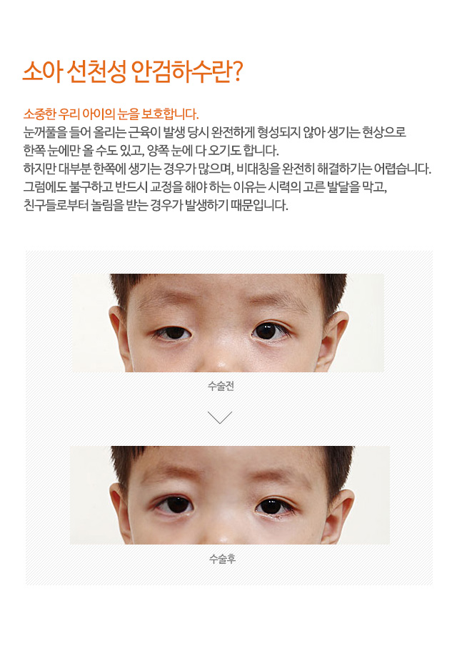 소아 선천성 안검하수란?
소중한 우리 아이의 눈을 보호합니다.
눈꺼풀을 들어 올리는 근육이 발생 당시 완전하게 형성되지 않아 생기는 현상으로
한쪽 눈에만 올 수도 있고, 양쪽 눈에 다 오기도 합니다.
하지만 대부분 한쪽에 생기는 경우가 많으며, 비대칭을 완전히 해결하기는 어렵습니다.
그럼에도 불구하고 반드시 교정을 해야 하는 이유는 시력의 고른 발달을 막고,
친구들로부터 놀림을 받는 경우가 발생하기 때문입니다.