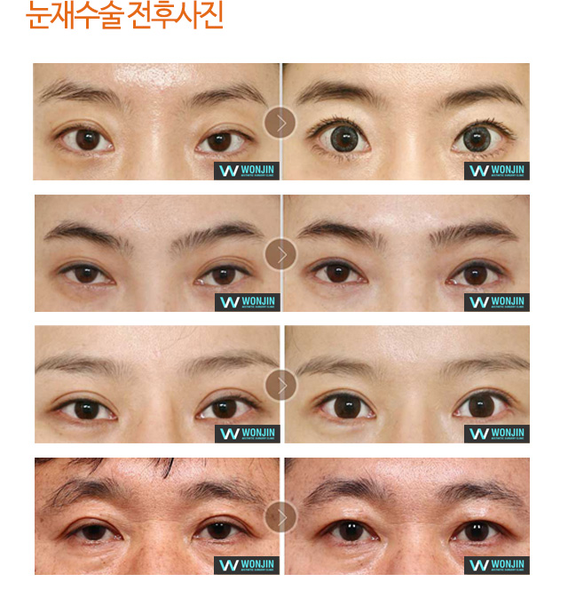 눈재수술 전후사진