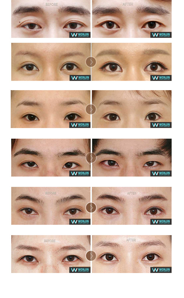 눈재수술 전후사진