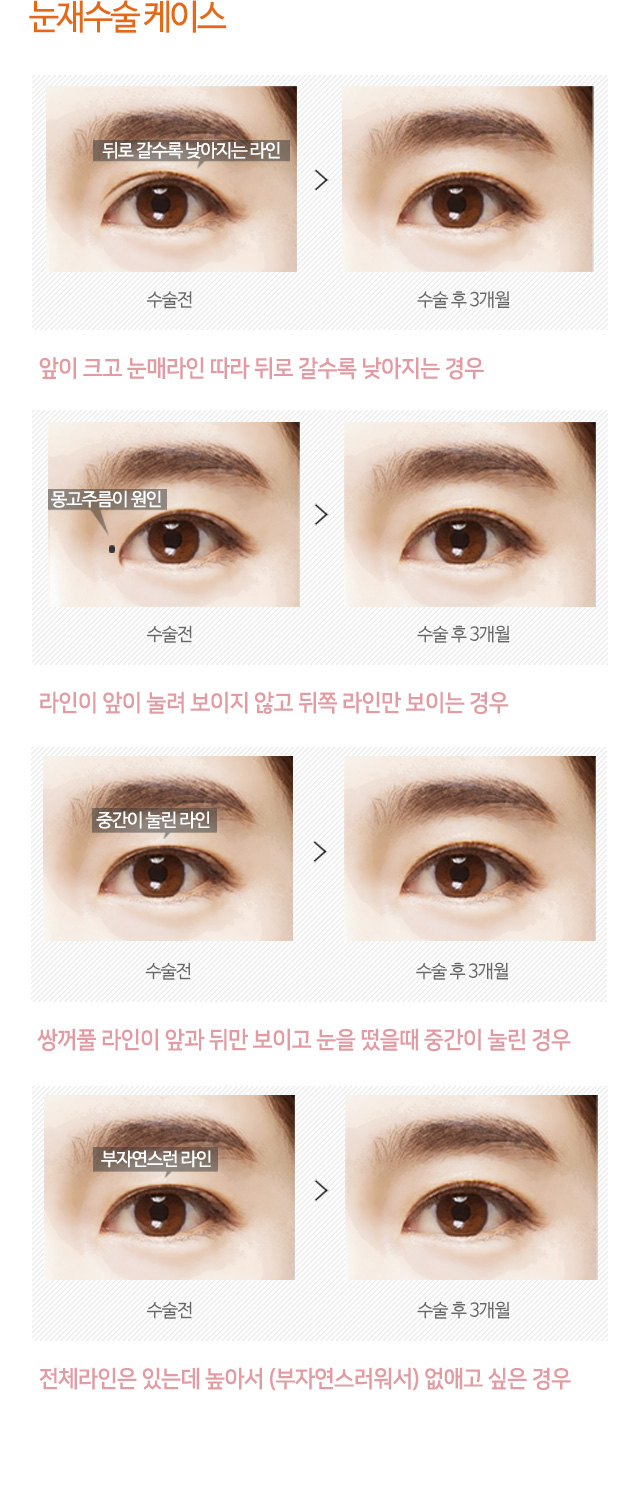 눈재수술 케이스
01.앞이 크고 눈매라인 따라 뒤로 갈수록 낮아지는 경우
02.라인이 앞이 눌려 보이지 않고 뒤쪽 라인만 보이는 경우
03.쌍꺼풀 라인이 앞과 뒤만 보이고 눈을 떴을때 중간이 눌린 경우
04.전체라인은 있는데 높아서 (부자연스러워서) 없애고 싶은 경우