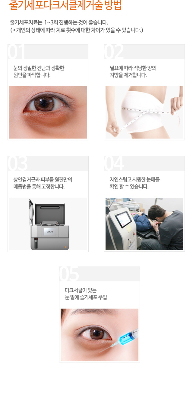 줄기세포다크서클제거술 방법
01.눈의 정밀한 진단과 정확한 원인을 파악합니다.
02.필요에 따라 적당한 양의 지방을 제거합니다.
03.상안검거근과 피부를 원진만의 매듭법을 통해 고정합니다.
04.자연스럽고 시원한 눈매를 확인 할 수 있습니다.
05.다크서클이 있는 눈 밑에 줄기세포 주입