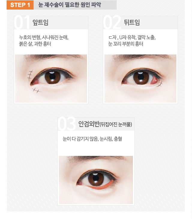 step1.눈 재수술이 필요한 원인 파악