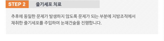 step2.줄기세포 치료 추후에 동일한 문제가 발생하지 않도록 문제가 되는 부분에 지방조직에서 채취한 줄기세포를 주입하여 눈재건술을 진행합니다.