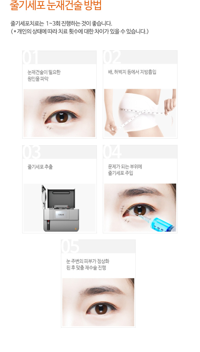 줄기세포 눈재건술 방법 줄기세포치료는 1~3회 진행하는 것이 좋습니다.
01.눈재건술이 필요한 원인을 파악
02.배,허벅지 등에서 지방흡입
03.줄기세포 추출
04.문제가 되는 부위에 줄기세포 주입
05.눈 주변의 피부가 정상화된 후 맞춤 재수술 진행