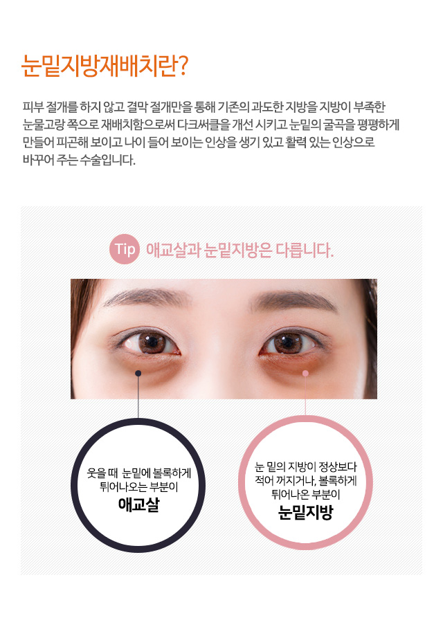 눈밑지방재배치란?
피부 절개를 하지 않고 결막 절개만을 통해 기존의 과도한 지방을 지방이 부족한
눈물고랑 쪽으로 재배치함으로써 다크써클을 개선 시키고 눈밑의 굴곡을 평평하게
만들어 피곤해 보이고 나이 들어 보이는 인상을 생기 있고 활력 있는 인상으로
바꾸어 주는 수술입니다.
TIP 애교살과 눈밑지방은 다릅니다.
웃을 때 눈밑에 볼록하게 튀어나오는 부분이 애교살
눈 밑의 지방이 정상보다 적어 꺼지거나, 볼록하게 튀어나온 부분이 눈밑지방