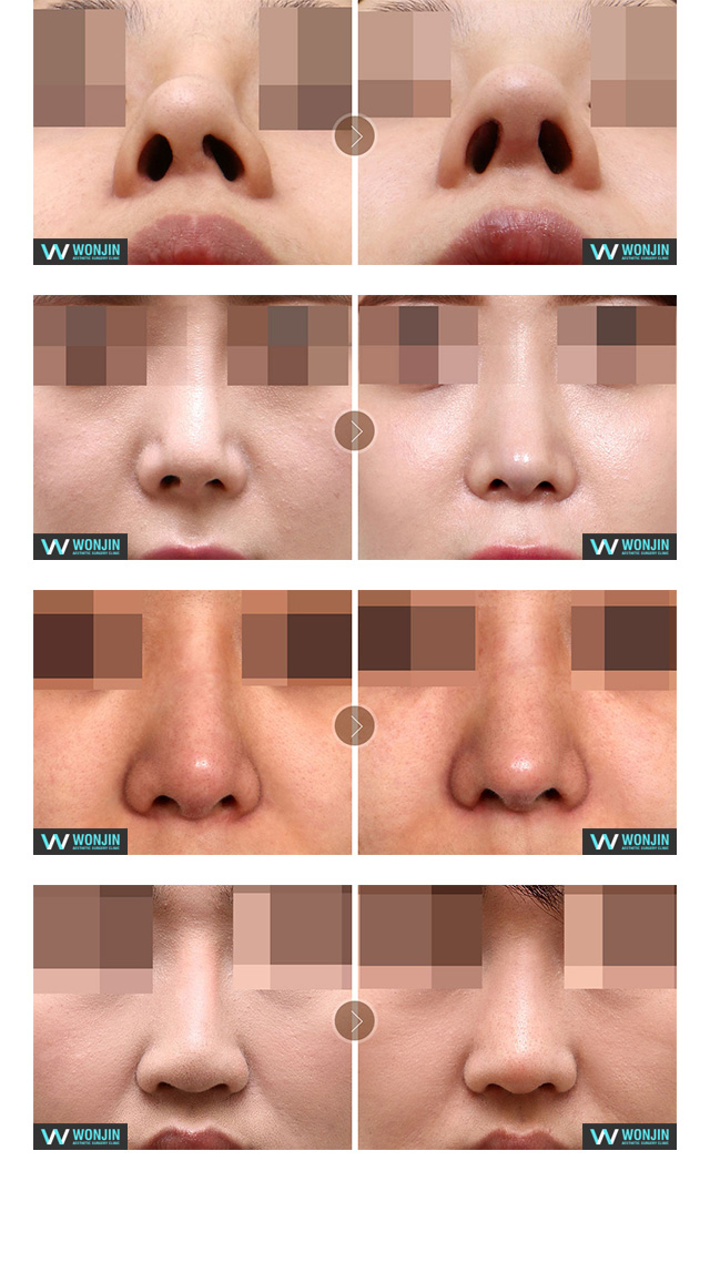 휜코성형 수술전후