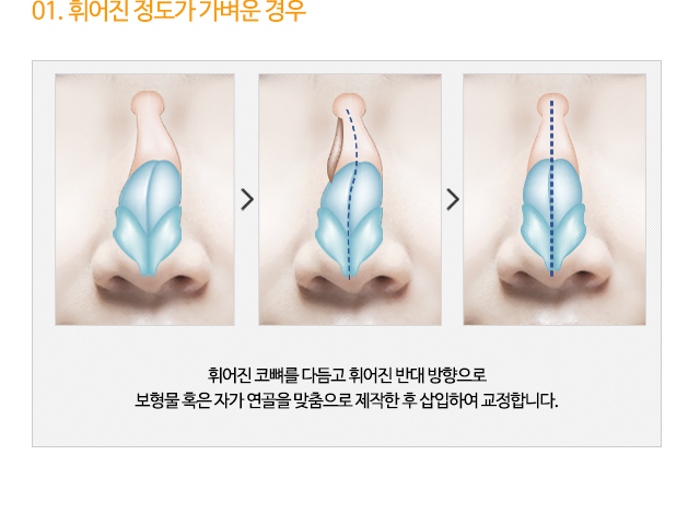 01. 휘어진 정도가 가벼운 경우
휘어진 코뼈를 다듬고 휘어진 반대 방향으로
보형물 혹은 자가 연골을 맞춤으로 제작한 후 삽입하여 교정합니다.