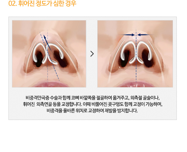 02. 휘어진 정도가 심한 경우
비중격만곡증 수술과 함께 코뼈 바깥쪽을 절골하여 옮겨주고, 외측절 골술이나,
휘어진 외측연골 등을 교정합니다. 이때 비뚤어진 콧구멍도 함께 교정이 가능하며,
비중격을 올바른 위치로 교정하여 재발을 방지합니다.
