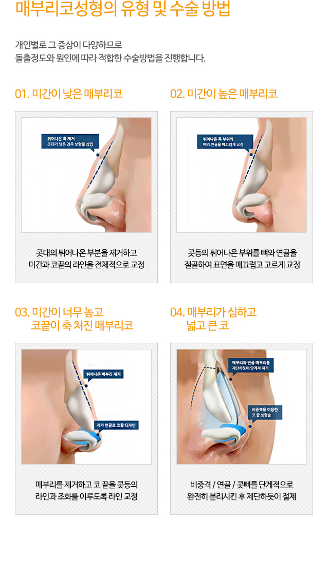 매부리코성형의 유형 및 수술 방법 개인별로 그 증상이 다양하므로
돌출정도와 원인에 따라 적합한 수술방법을 진행합니다.