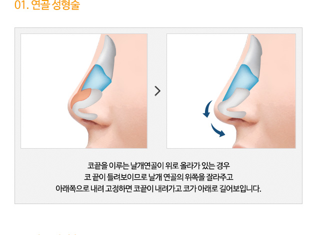 01. 연골 성형술 코끝을 이루는 날개연골이 위로 올라가 있는 경우
코 끝이 들려보이므로 날개 연골의 위쪽을 잘라주고 아래쪽으로 내려 고정하면 코끝이 내려가고 코가 아래로 길어보입니다.
