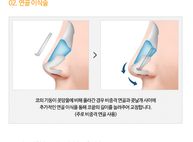 02. 연골 이식술