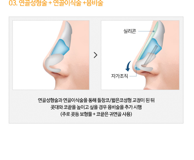 03. 연골성형술+연골이식술+융비술