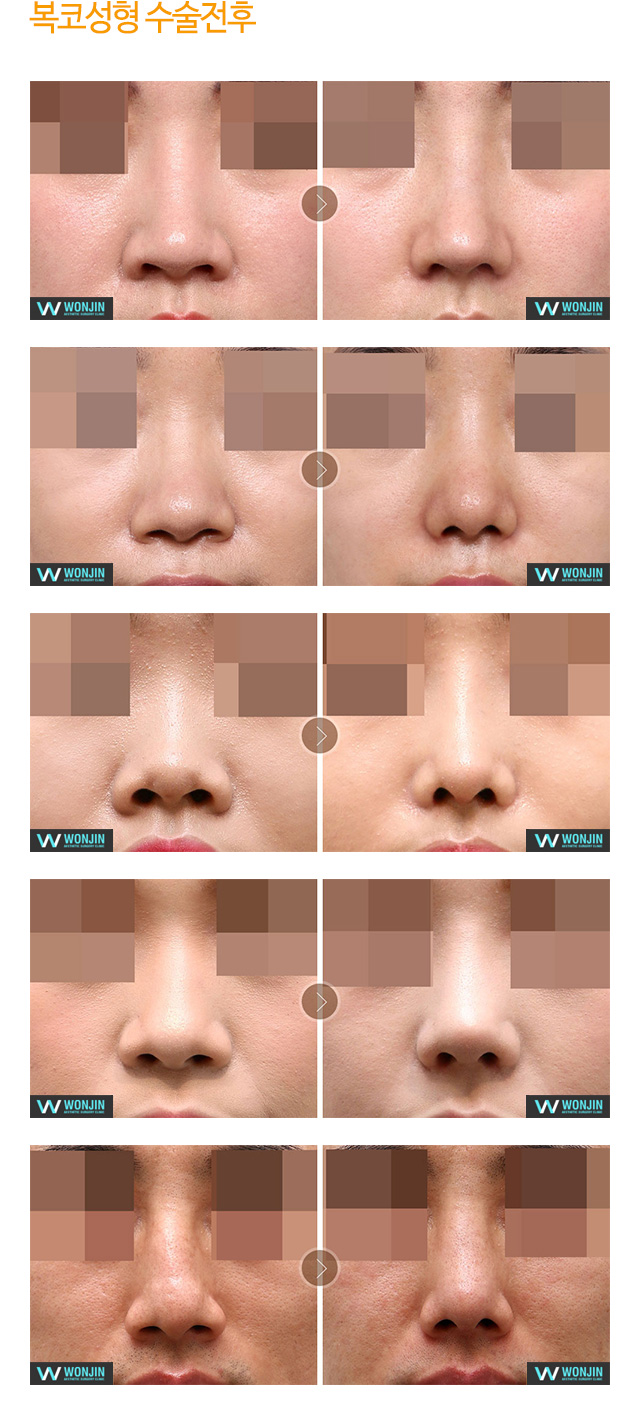 복코성형 수술전후