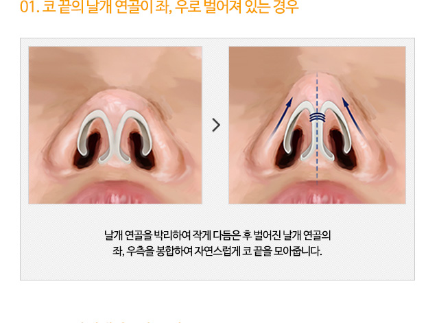 01. 코 끝의 날개 연골이 좌, 우로 벌어져 있는 경우 날개 연골을 박리하여 작게 다듬은 후 벌어진 날개 연골의 좌, 우측을 봉합하여 자연스럽게 코 끝을 모아줍니다.