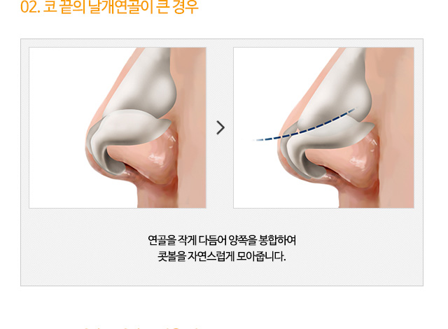 02. 코 끝의 날개연골이 큰 경우 연골을 작게 다듬어 양쪽을 봉합하여 콧볼을 자연스럽게 모아줍니다.
