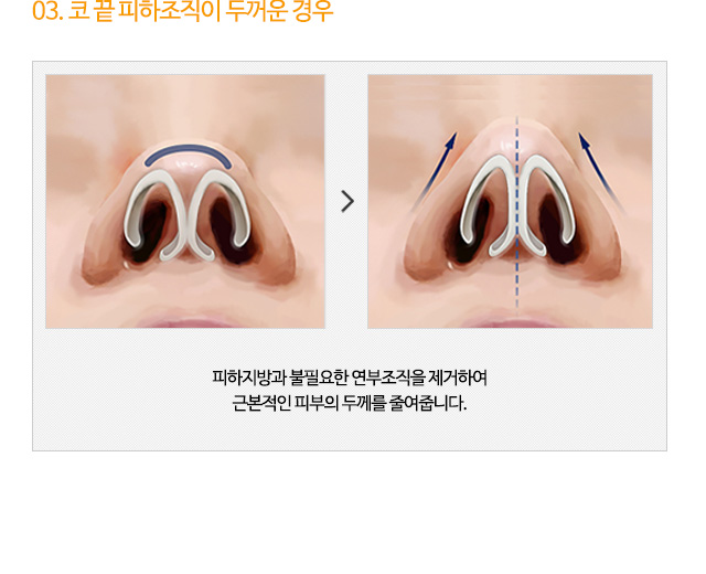 03. 코 끝 피하조직이 두꺼운 경우 피하지방과 불필요한 연부조직을 제거하여 근본적인 피부의 두께를 줄여줍니다.