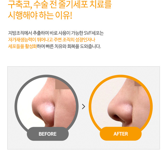 구축코, 수술 전 줄기세포 치료를 시행해야 하는 이유!
지방조직에서 추출하여 바로 사용이 가능한 SVF세포는
자가재생능력이 뛰어나고 주변 조직의 성장인자나
세포들을 활성화하여 빠른 치유와 회복을 도와줍니다.