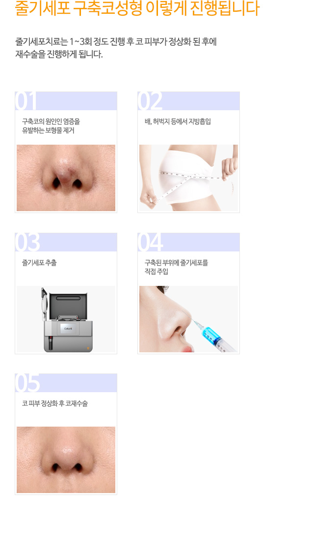 줄기세포 구축코성형 이렇게 진행됩니다 줄기세포치료는 1~3회 정도 진행 후 코 피부가 정상화 된 후에
재수술을 진행하게 됩니다.