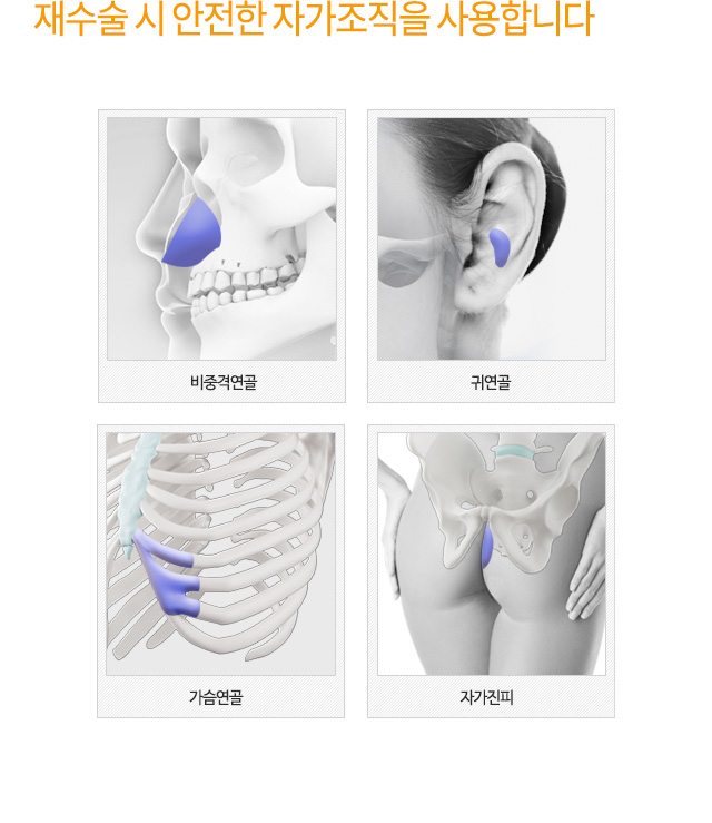 재수술 시 안전한 자가조직을 사용합니다 : 비중격연골,귀연골,가슴연골,자가진피