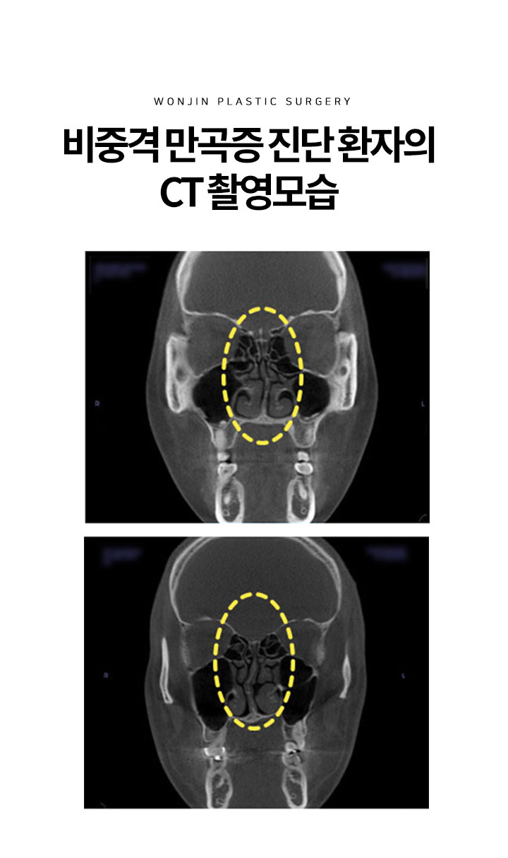 비중격 만곡증 진단 환자의 CT 촬영모습