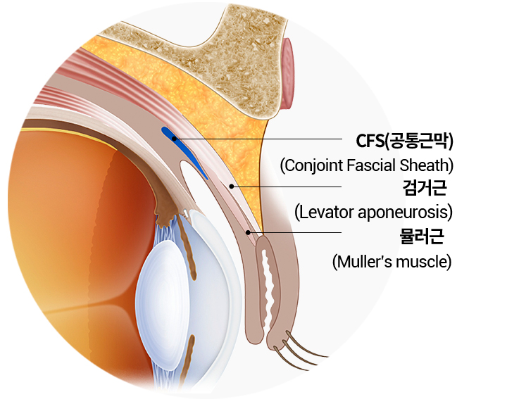 CFS 공통근막 눈매교정 수술 포인트 이미지