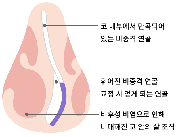 코 내부에서 만곡되어 있는 비중격 연골, 휘어진 비중격 연골 교정 시 얻게 되는 연골, 비후성 비염으로 인해 비대해진 코 안의 살 조직 이미지