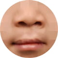 구순구개열 성형 이미지