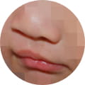 구순구개열 성형 이미지