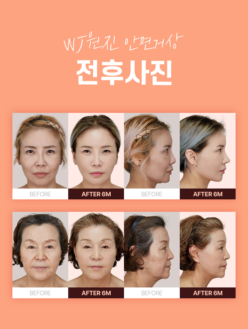 광고랜딩