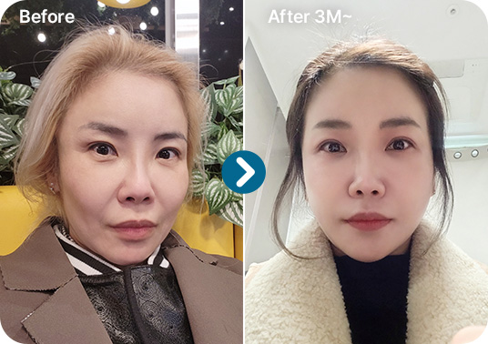 리프팅