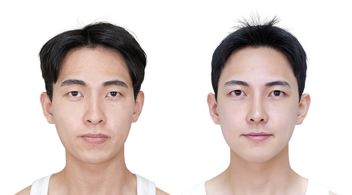 성형 전/후 이미지