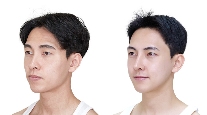 성형 전/후 이미지