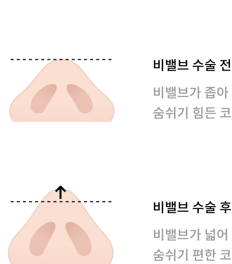 비밸브 수술 전(비밸브가 좁아 숨쉬기 힘든 코), 비밸브 수술 후(비밸브가 넓어 숨쉬기 편한 코) 이미지